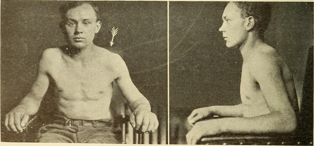 An illustration from Fractures and dislocations, diagnosis and treatment, 1915, leaf 49