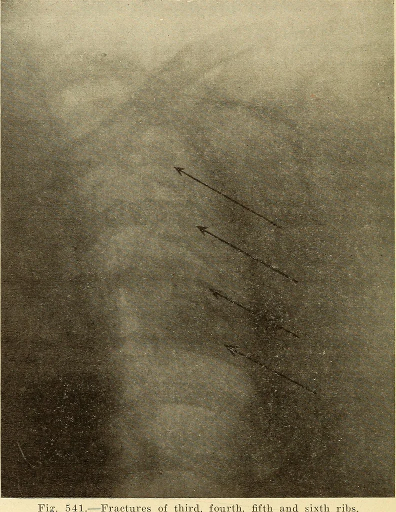 An illustration from Fractures and dislocations, diagnosis and treatment, 1915, leaf 491