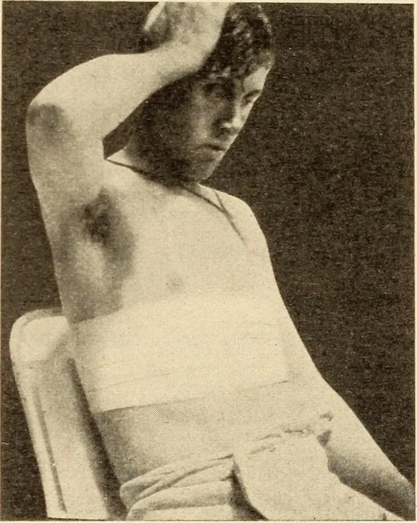 An illustration from Fractures and dislocations, diagnosis and treatment, 1915, leaf 494
