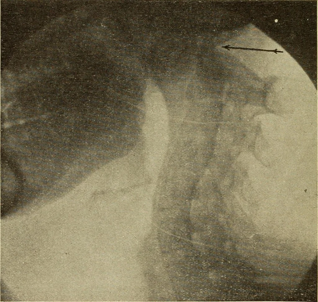 An illustration from Fractures and dislocations, diagnosis and treatment, 1915, leaf 499
