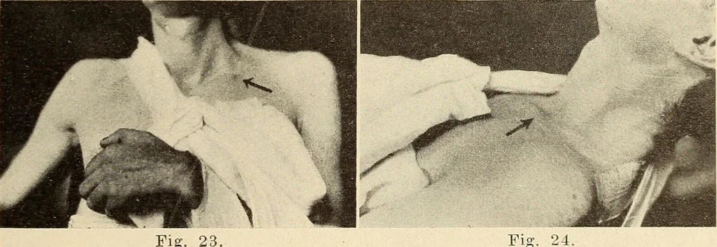 An illustration from Fractures and dislocations, diagnosis and treatment, 1915, leaf 50
