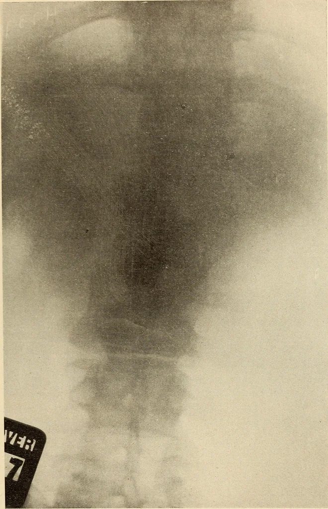 An illustration from Fractures and dislocations, diagnosis and treatment, 1915, leaf 500