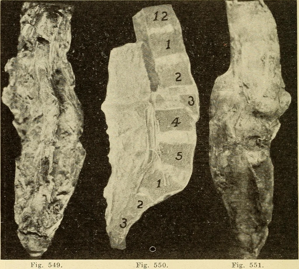 An illustration from Fractures and dislocations, diagnosis and treatment, 1915, leaf 501