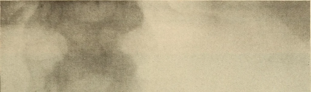 An illustration from Fractures and dislocations, diagnosis and treatment, 1915, leaf 502
