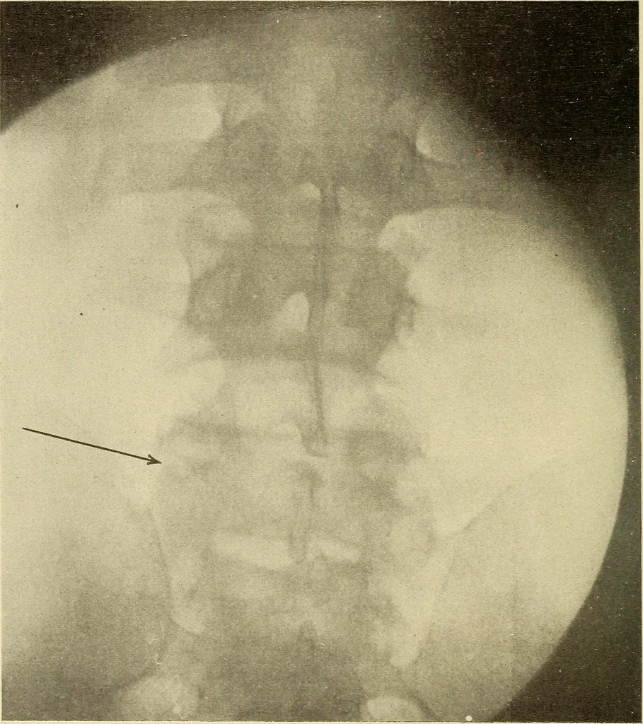 An illustration from Fractures and dislocations, diagnosis and treatment, 1915, leaf 503