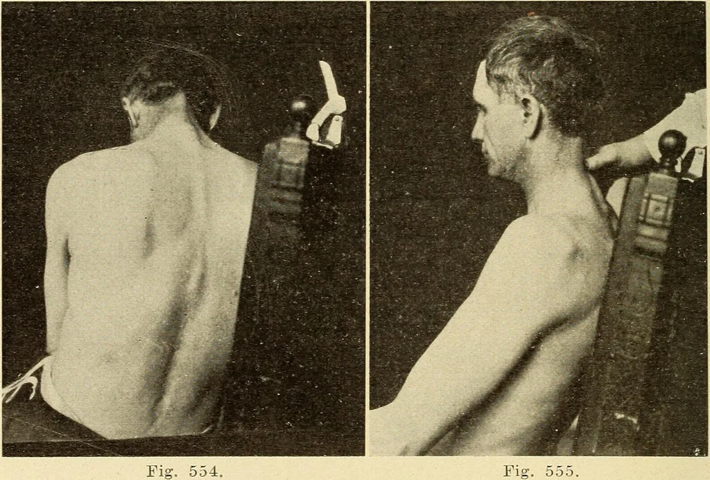 An illustration from Fractures and dislocations, diagnosis and treatment, 1915, leaf 505