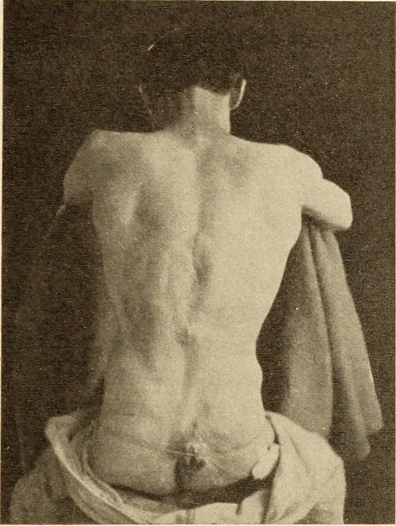 An illustration from Fractures and dislocations, diagnosis and treatment, 1915, leaf 508