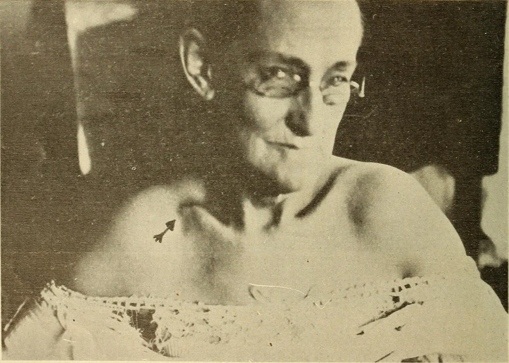 An illustration from Fractures and dislocations, diagnosis and treatment, 1915, leaf 51