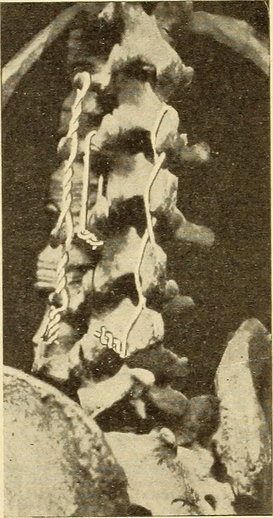 An illustration from Fractures and dislocations, diagnosis and treatment, 1915, leaf 519