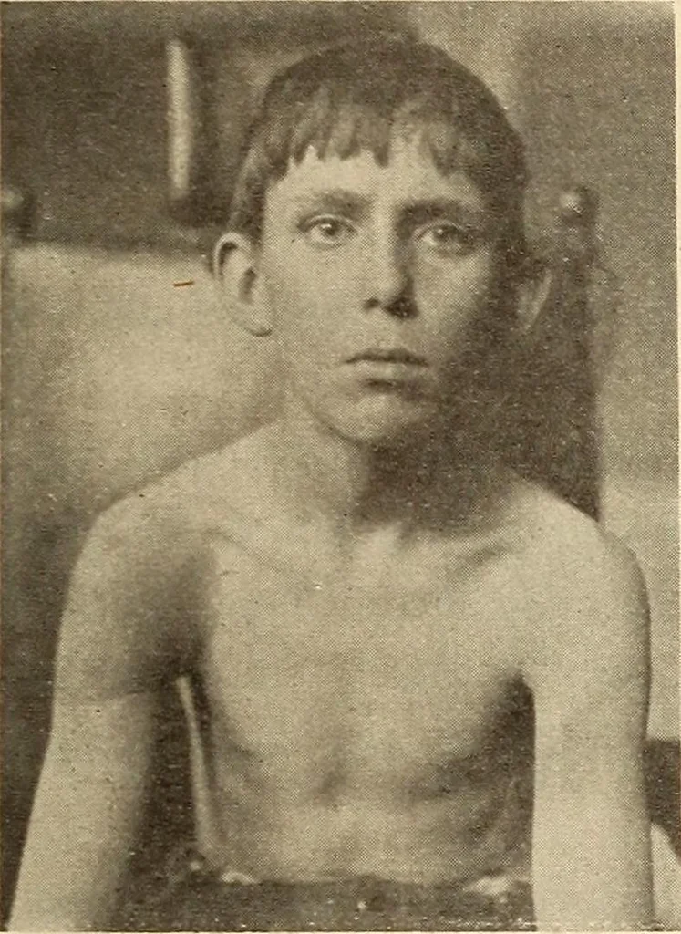 An illustration from Fractures and dislocations, diagnosis and treatment, 1915, leaf 52