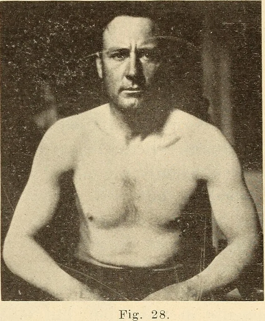 An illustration from Fractures and dislocations, diagnosis and treatment, 1915, leaf 52