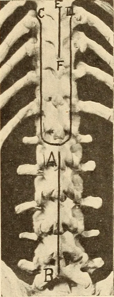 An illustration from Fractures and dislocations, diagnosis and treatment, 1915, leaf 520