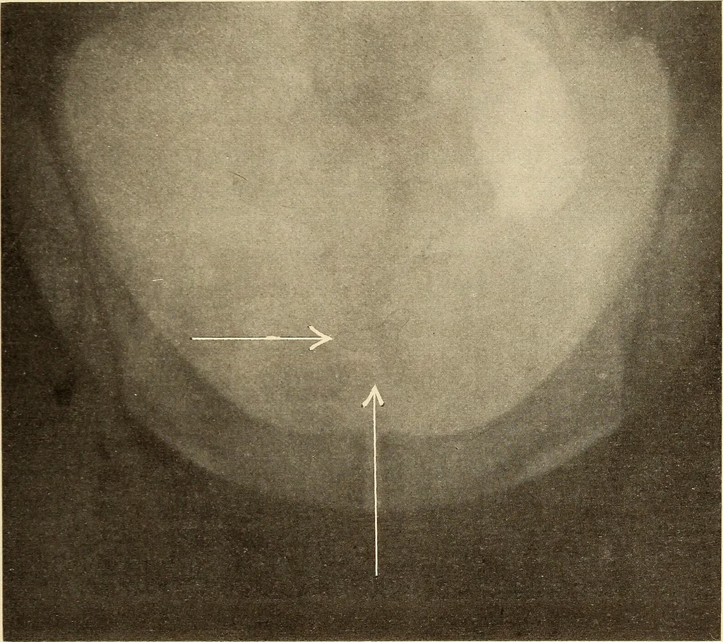 An illustration from Fractures and dislocations, diagnosis and treatment, 1915, leaf 532