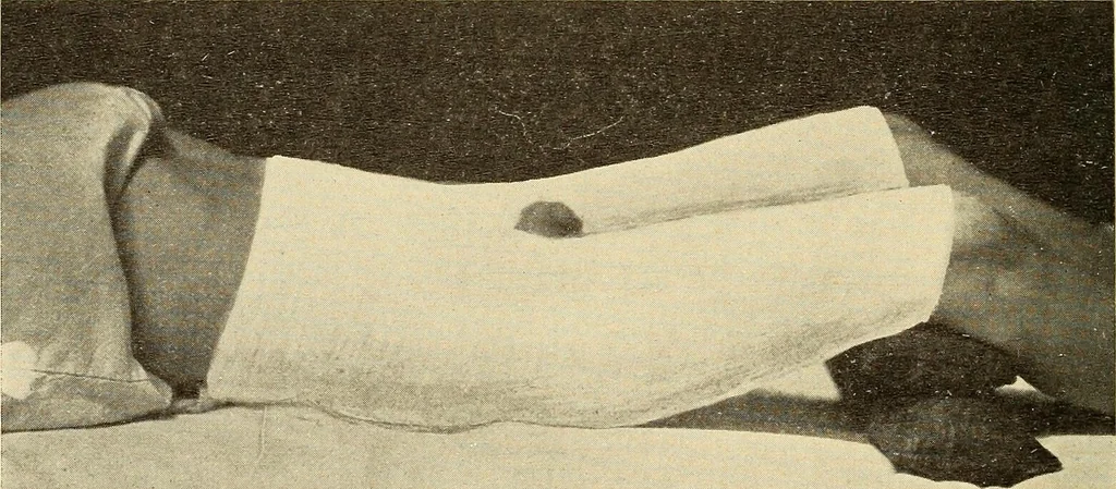 An illustration from Fractures and dislocations, diagnosis and treatment, 1915, leaf 539