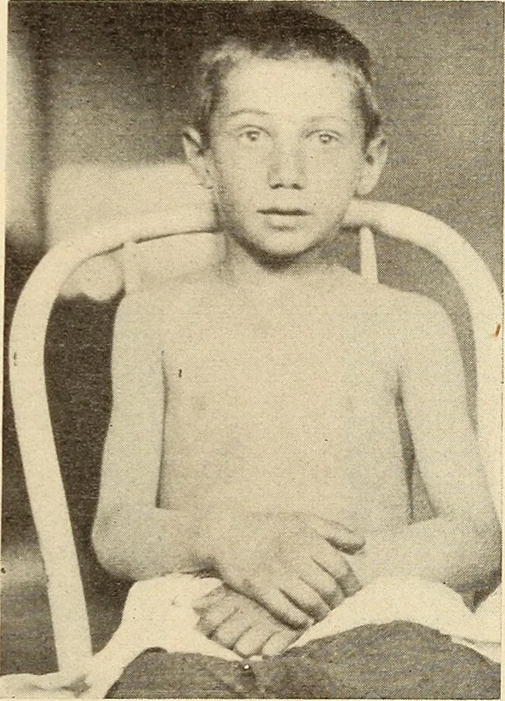 An illustration from Fractures and dislocations, diagnosis and treatment, 1915, leaf 54