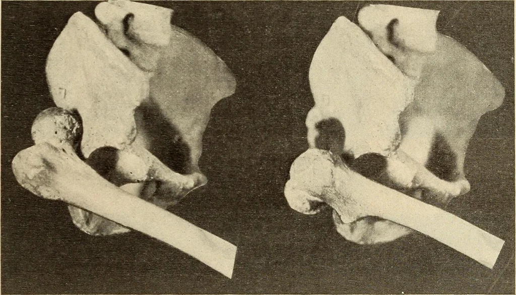 An illustration from Fractures and dislocations, diagnosis and treatment, 1915, leaf 548