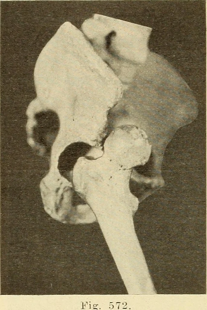 An illustration from Fractures and dislocations, diagnosis and treatment, 1915, leaf 549
