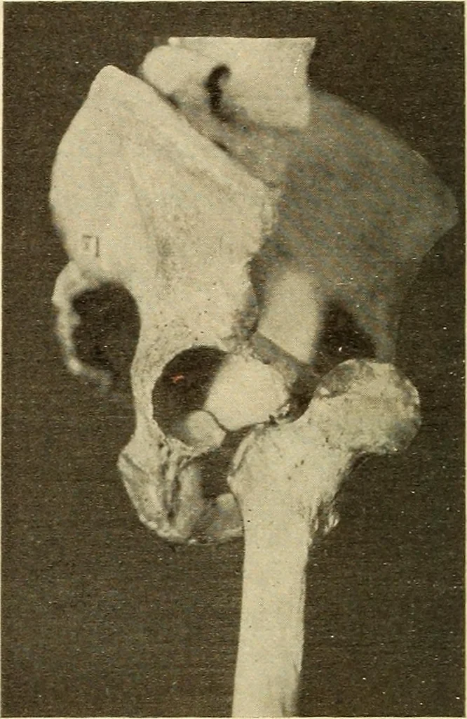 An illustration from Fractures and dislocations, diagnosis and treatment, 1915, leaf 549