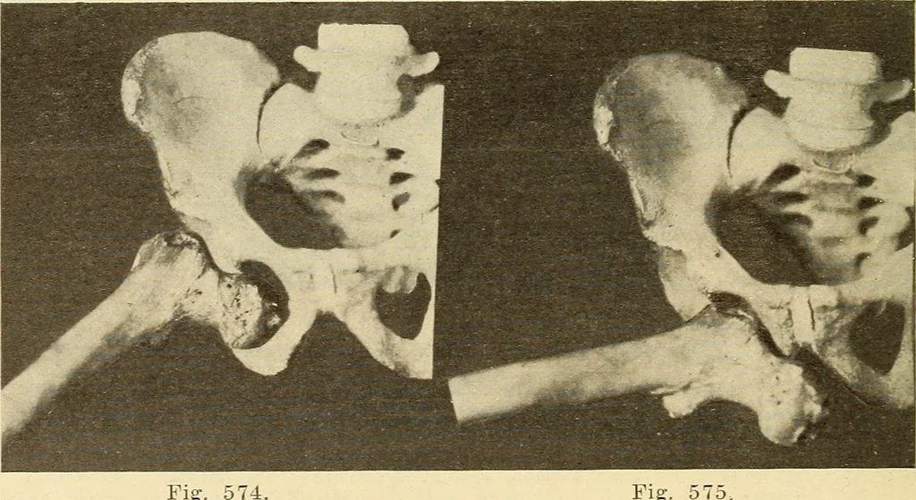 An illustration from Fractures and dislocations, diagnosis and treatment, 1915, leaf 549