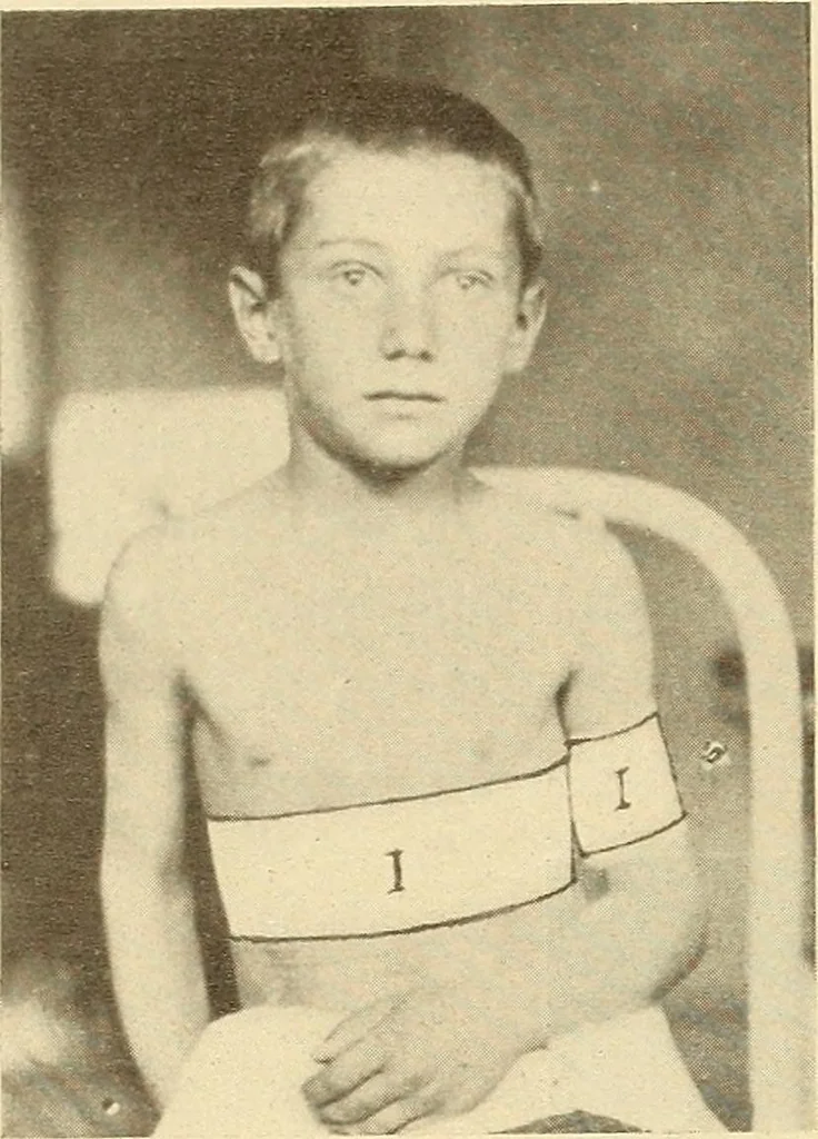 An illustration from Fractures and dislocations, diagnosis and treatment, 1915, leaf 55