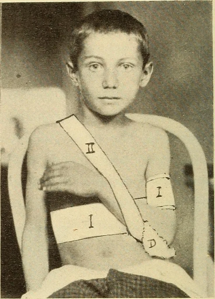 An illustration from Fractures and dislocations, diagnosis and treatment, 1915, leaf 55