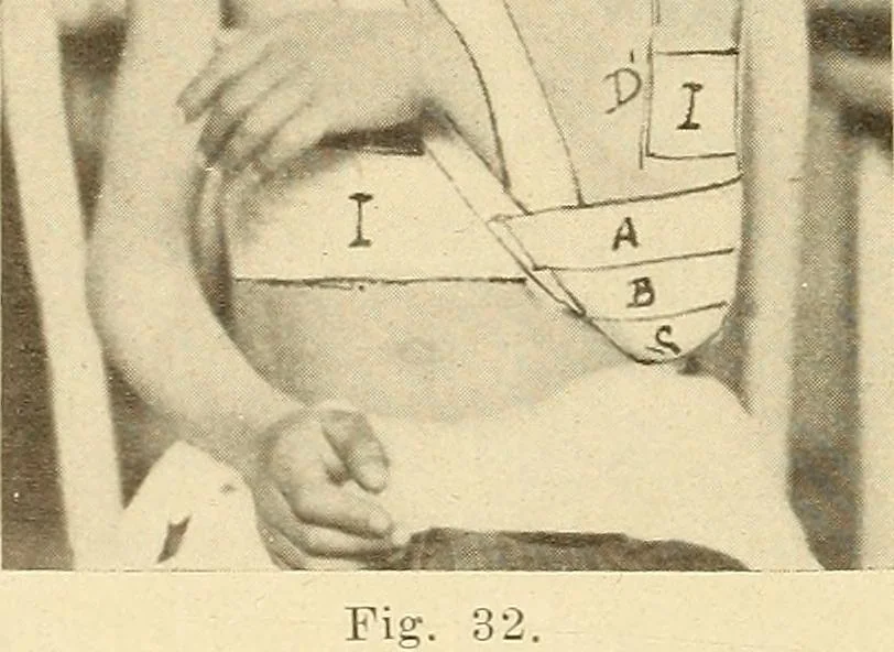 An illustration from Fractures and dislocations, diagnosis and treatment, 1915, leaf 55