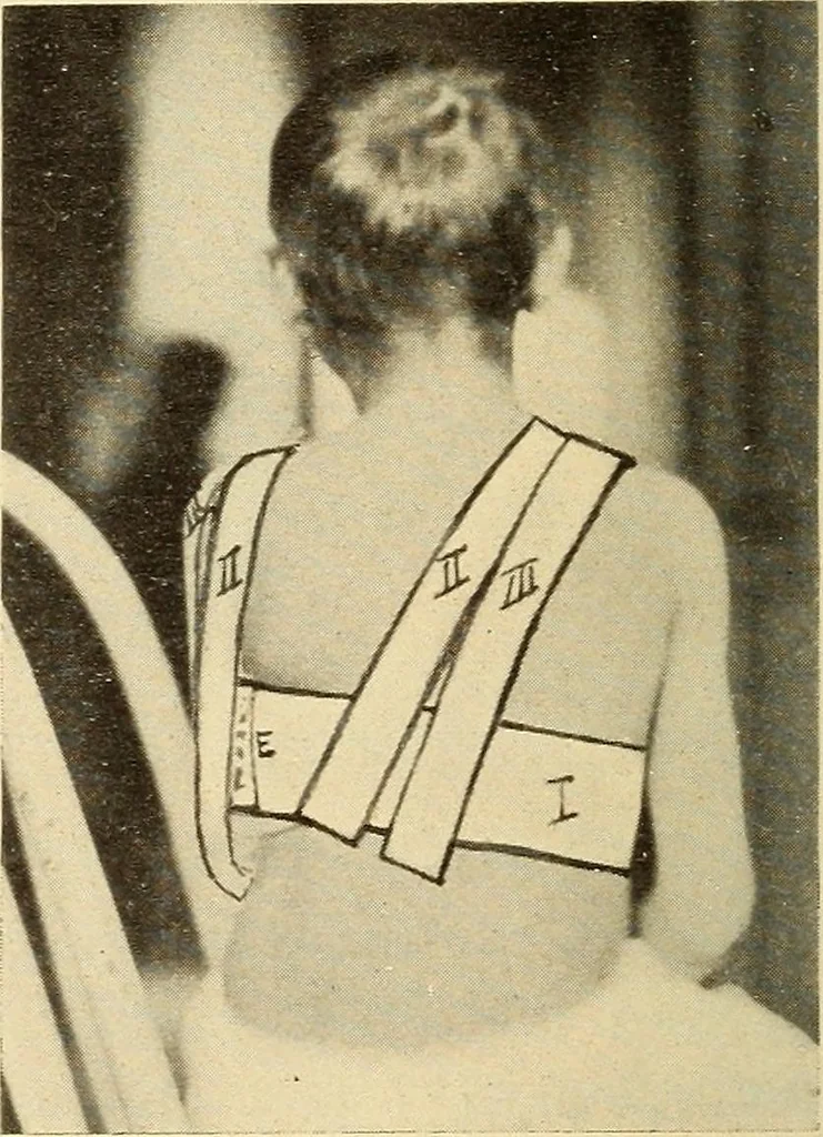 An illustration from Fractures and dislocations, diagnosis and treatment, 1915, leaf 55