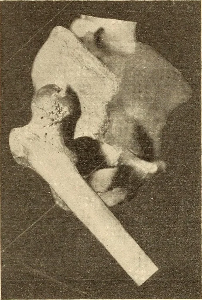 An illustration from Fractures and dislocations, diagnosis and treatment, 1915, leaf 550
