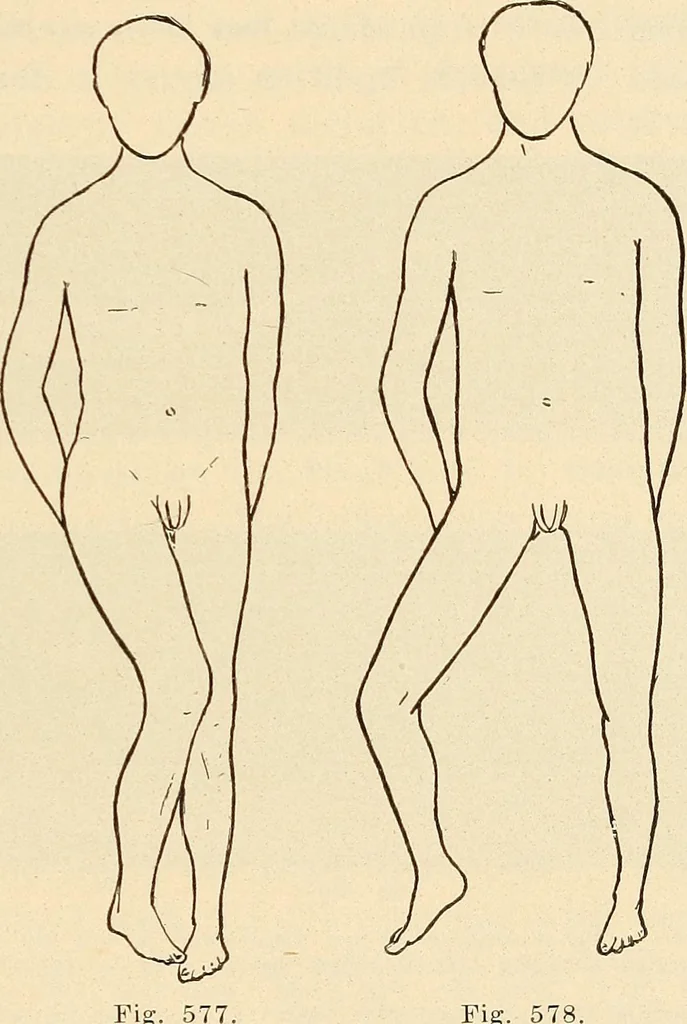 An illustration from Fractures and dislocations, diagnosis and treatment, 1915, leaf 552