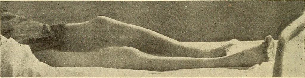 An illustration from Fractures and dislocations, diagnosis and treatment, 1915, leaf 553