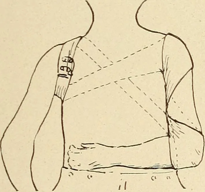 An illustration from Fractures and dislocations, diagnosis and treatment, 1915, leaf 56