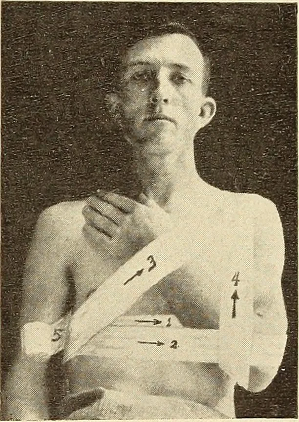 An illustration from Fractures and dislocations, diagnosis and treatment, 1915, leaf 56