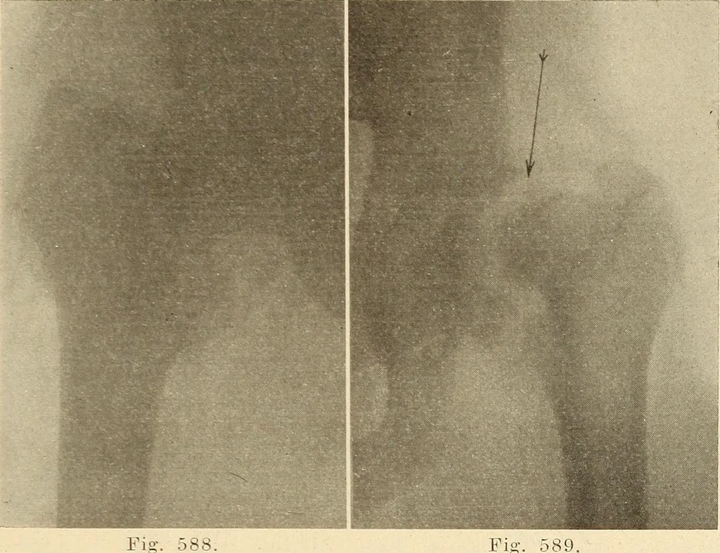 An illustration from Fractures and dislocations, diagnosis and treatment, 1915, leaf 566