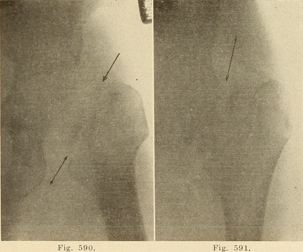 An illustration from Fractures and dislocations, diagnosis and treatment, 1915, leaf 566