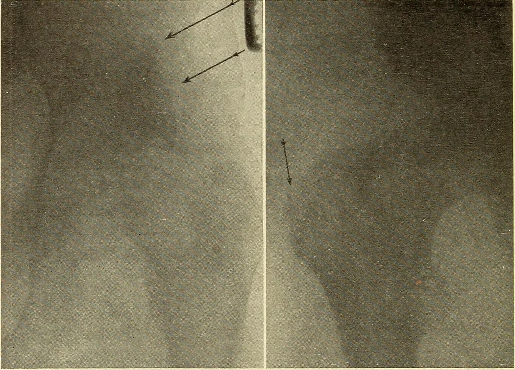 An illustration from Fractures and dislocations, diagnosis and treatment, 1915, leaf 567