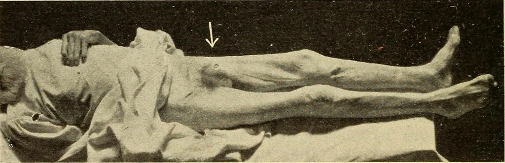 An illustration from Fractures and dislocations, diagnosis and treatment, 1915, leaf 569