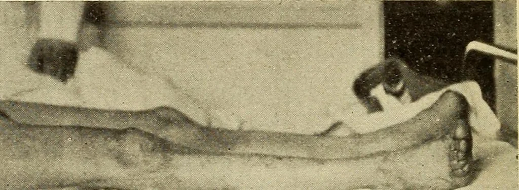 An illustration from Fractures and dislocations, diagnosis and treatment, 1915, leaf 569