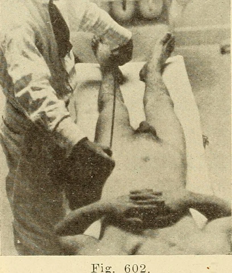 An illustration from Fractures and dislocations, diagnosis and treatment, 1915, leaf 571