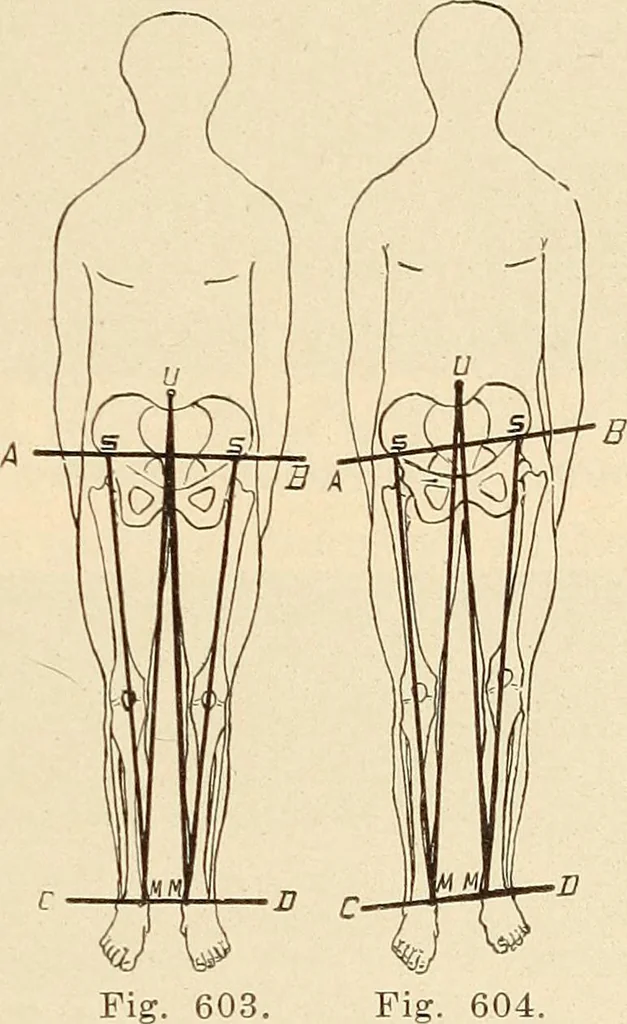 An illustration from Fractures and dislocations, diagnosis and treatment, 1915, leaf 572