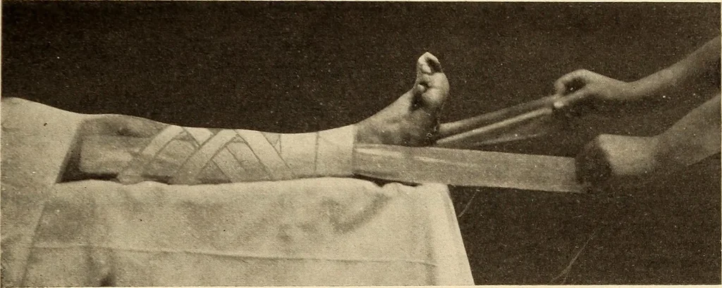 An illustration from Fractures and dislocations, diagnosis and treatment, 1915, leaf 574