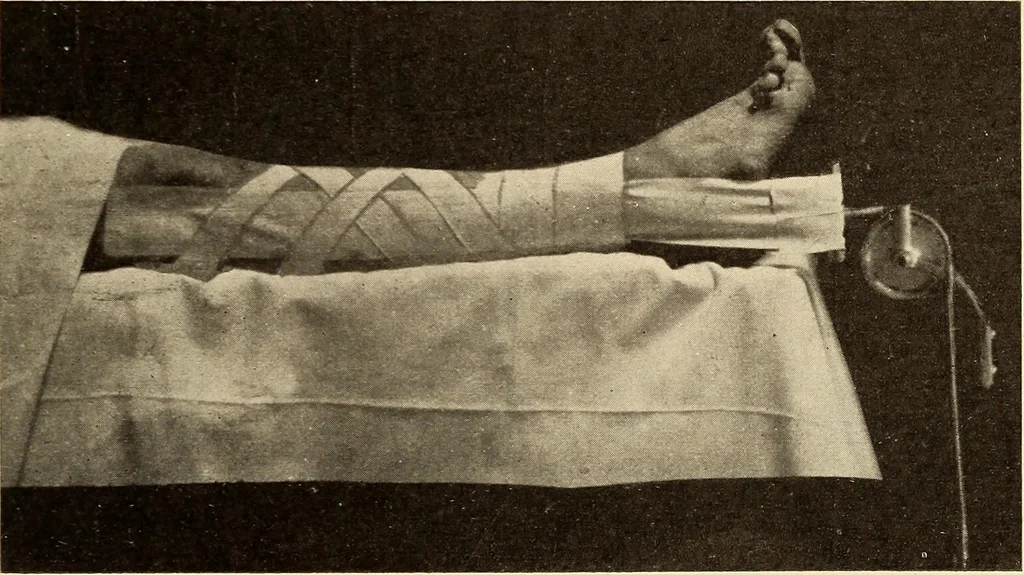 An illustration from Fractures and dislocations, diagnosis and treatment, 1915, leaf 574