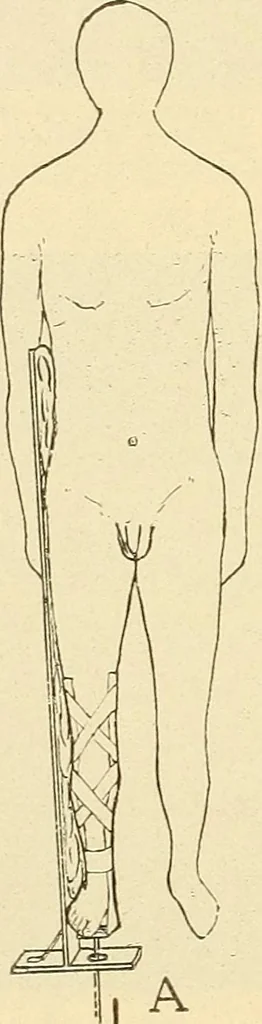 An illustration from Fractures and dislocations, diagnosis and treatment, 1915, leaf 575
