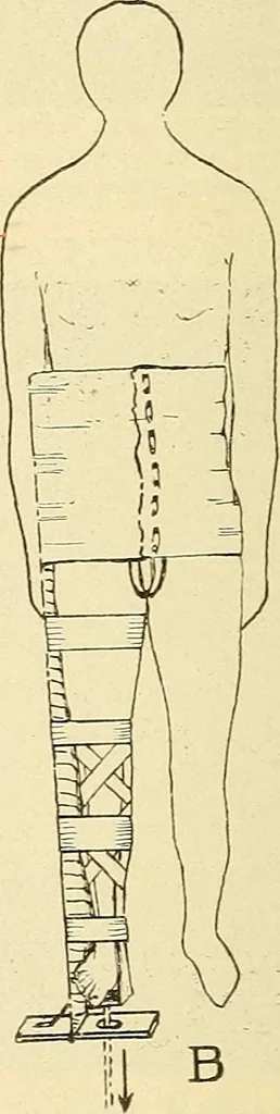 An illustration from Fractures and dislocations, diagnosis and treatment, 1915, leaf 575