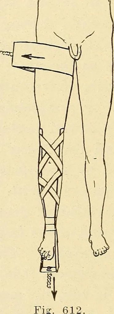 An illustration from Fractures and dislocations, diagnosis and treatment, 1915, leaf 577