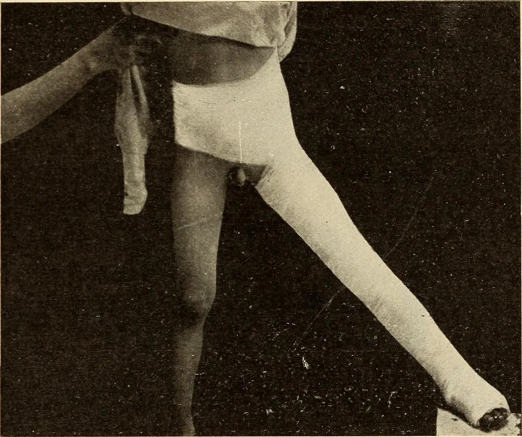 An illustration from Fractures and dislocations, diagnosis and treatment, 1915, leaf 578