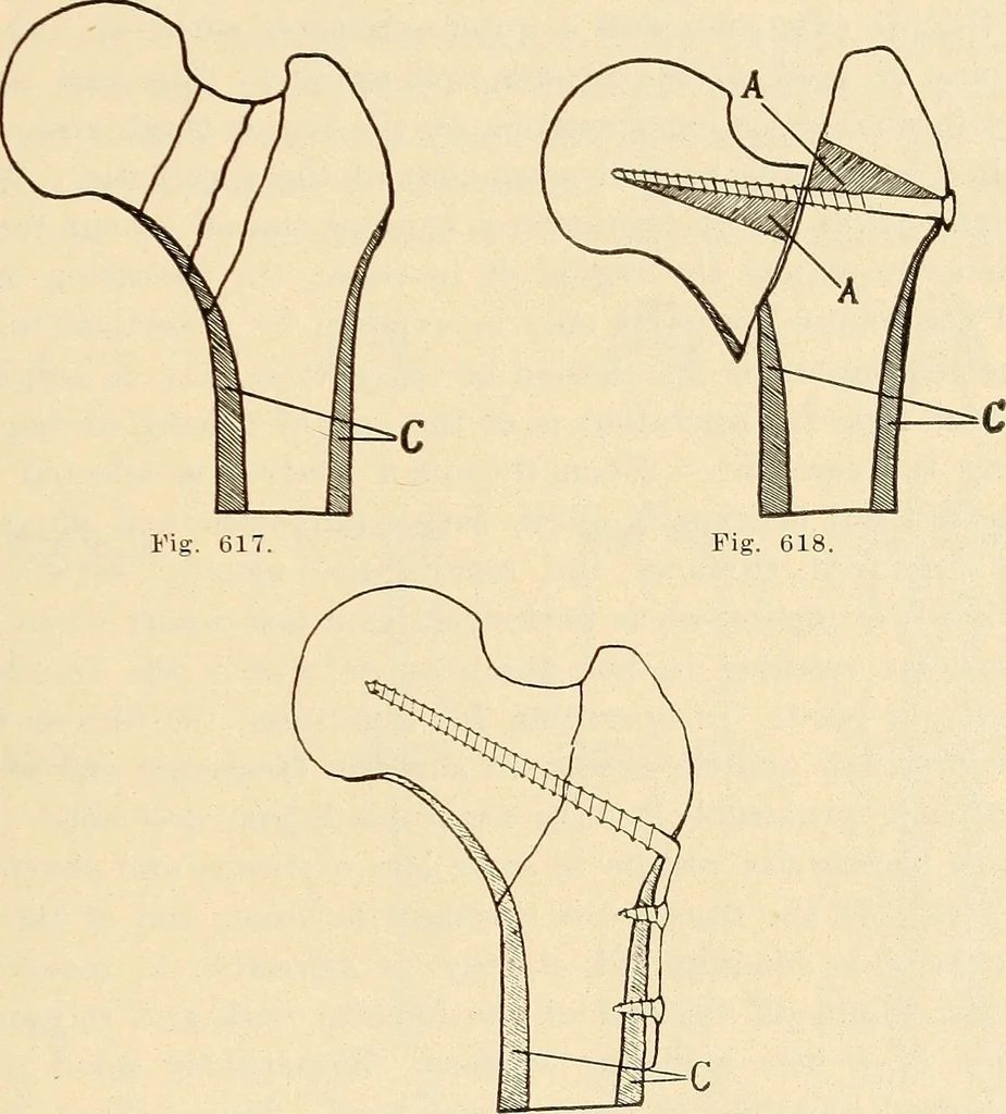 An illustration from Fractures and dislocations, diagnosis and treatment, 1915, leaf 582