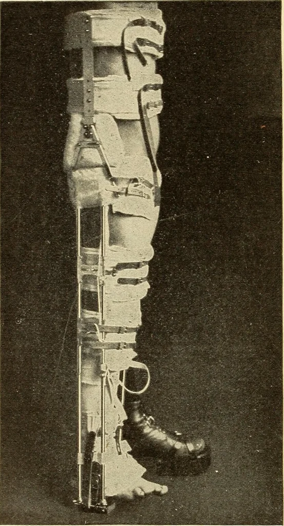 An illustration from Fractures and dislocations, diagnosis and treatment, 1915, leaf 585