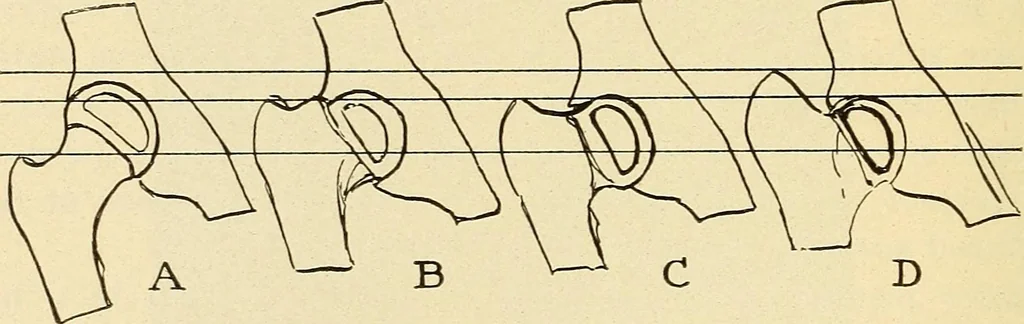 An illustration from Fractures and dislocations, diagnosis and treatment, 1915, leaf 587