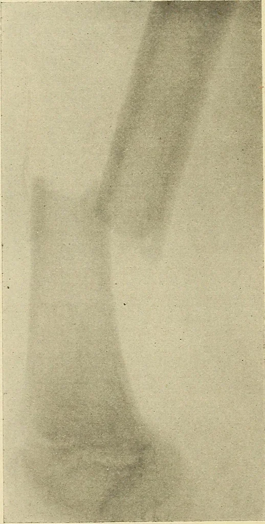 An illustration from Fractures and dislocations, diagnosis and treatment, 1915, leaf 591
