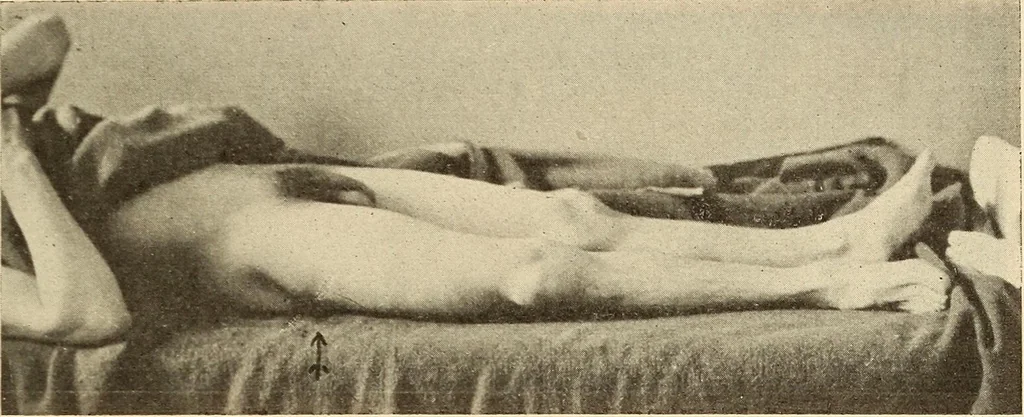 An illustration from Fractures and dislocations, diagnosis and treatment, 1915, leaf 592